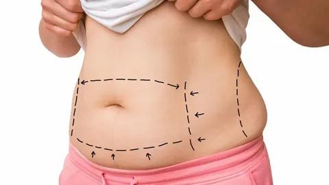 لاغری با دستگاه PAL | لیپوساکشن در آمل