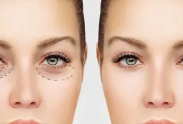 جراحی پلک در آمل