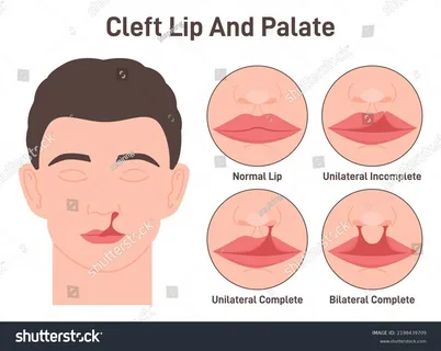 جراحی لب شکری و کام شکافته در آمل