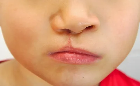 جراحی لب شکری و کام شکافته در آمل