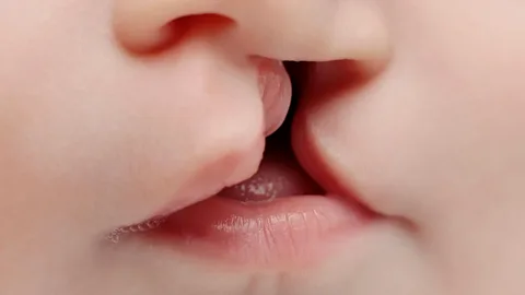 جراحی لب شکری و کام شکافته در آمل