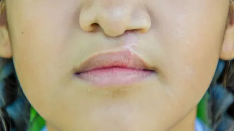 جراحی لب شکری و کام شکافته در آمل