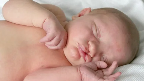 جراحی لب شکری و کام شکافته در آمل
