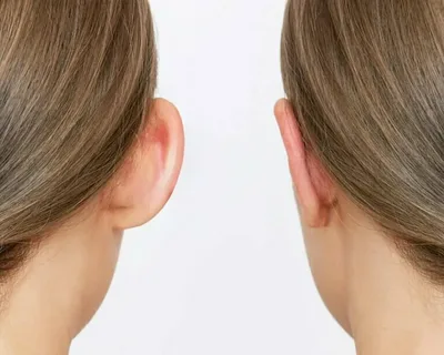 جراحی زیبایی و ترمیمی گوش (اتوپلاستی) در آمل