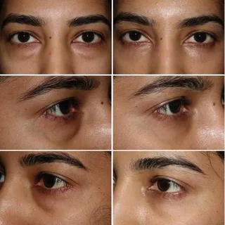 جراحی زیبایی پلک (بلفاروپلاستی) در آمل