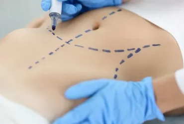 ابدمینوپلاستی و لیپو چیست؟