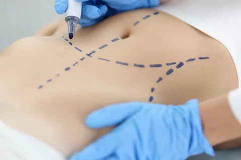 ابدمینوپلاستی و لیپو چیست؟