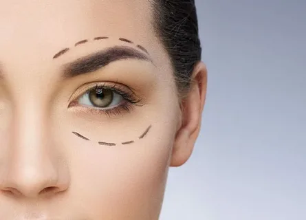 جراحی زیبایی پلک (بلفاروپلاستی) در آمل