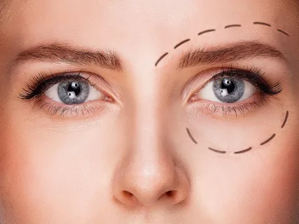 جراحی زیبایی پلک (بلفاروپلاستی) در آمل