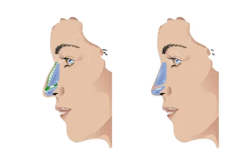 بهترین جراح بینی در آمل 7 بهترین جراح بینی در آمل