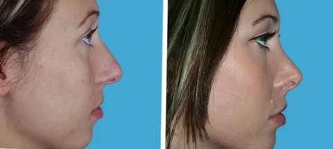 بهترین جراح بینی در آمل 1 بهترین جراح بینی در آمل