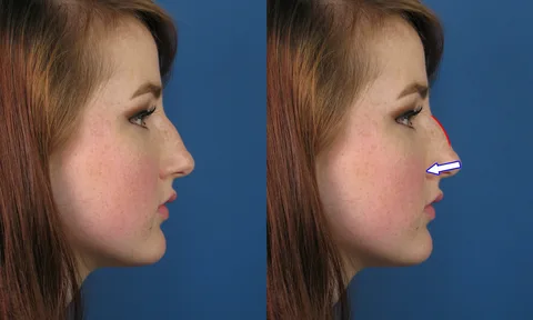 بهترین جراح بینی در آمل 12 بهترین جراح بینی در آمل